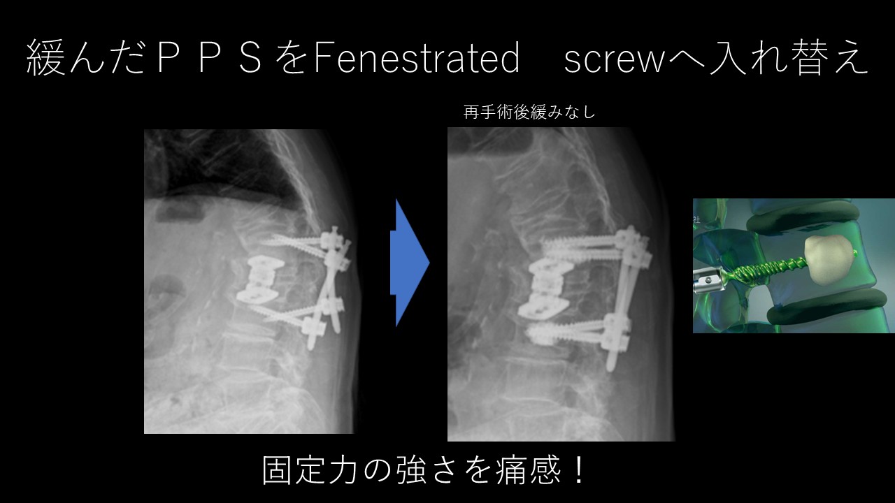 骨粗鬆症の脊椎固定術に革命！セメント強化スクリューの固定力と安全性