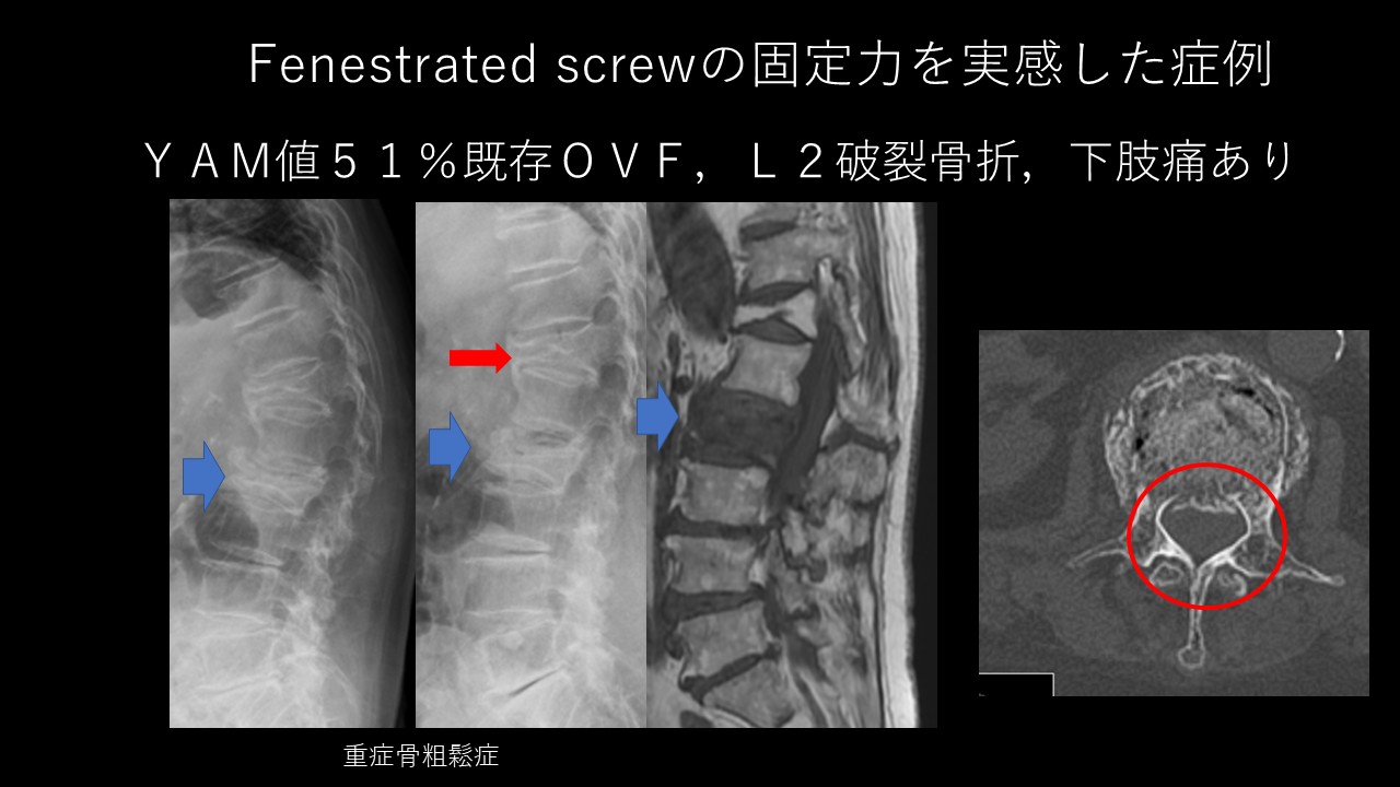 骨粗鬆症の脊椎固定術に革命！セメント強化スクリューの固定力と安全性