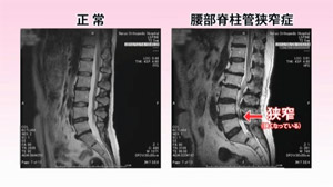 腰部脊柱管狭窄症について Vol.1